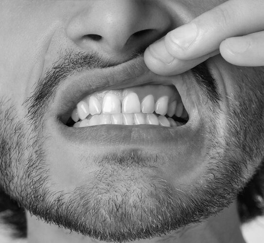 Periodontal-Gum-Disease