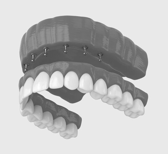 Snap-on-Dentures
