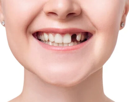 Why Is It Important to Replace Missing Teeth? A Comprehensive Guide