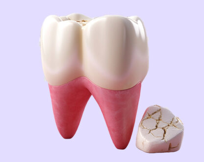 How Dentists Repair Broken Teeth: What to Expect During Your Visit