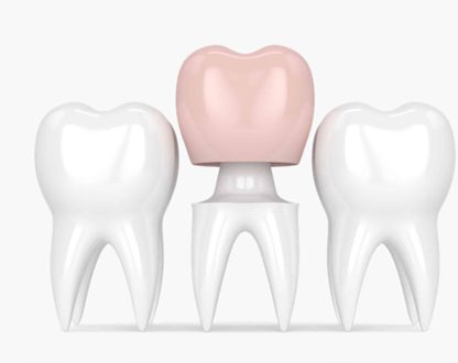 What to Do If Your Dental Crown Breaks: Key Steps and Treatment Options