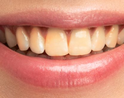Why Do Your Teeth Become Yellow? Common Causes & Solutions
