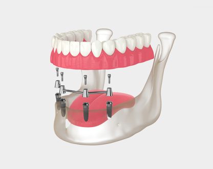 Healing Made Simple: What to Expect After All-on-4 Dental Implants
